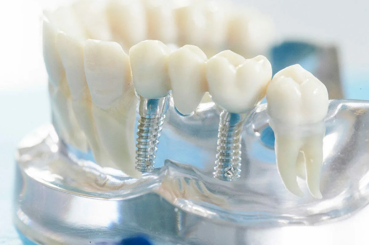 protezirovanie-zubov-2