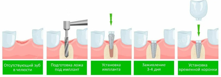 Основные этапы и особенности имплантации зубов