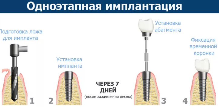 Основные этапы и особенности имплантации зубов