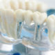 protezirovanie-zubov-2